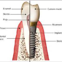 Implant圖片照片_Implant