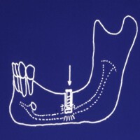 Implant圖片照片_Implant