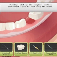 Implant圖片照片_Implant